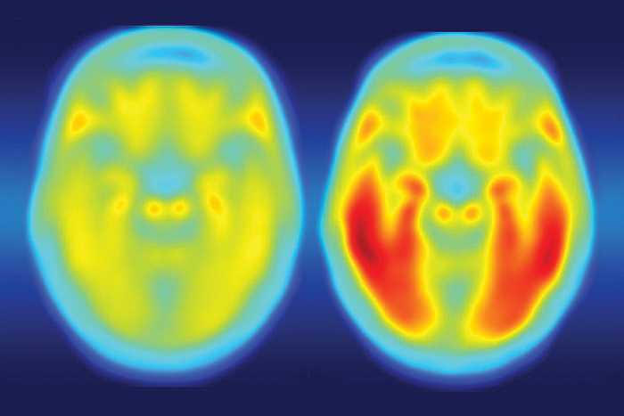 Colorful PET scan of two brains showing average tau accumulation in cognitively normal people (left) and in those with mild Alzheimer's symptoms.