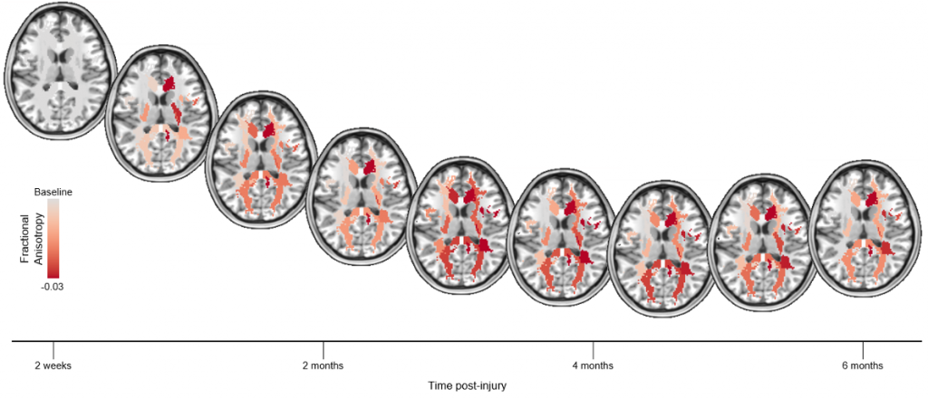 White matter fibers are progressively altered over the course of a six-month recovery period following a traumatic brain injury.