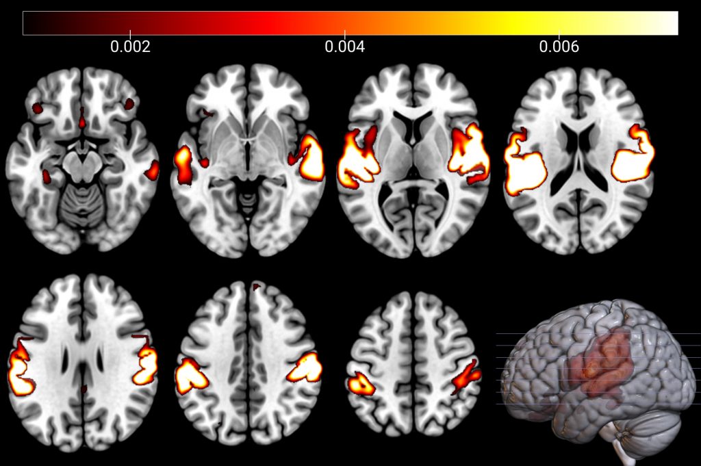 Late-life depression was significantly associated with reduced volume within this structural network, which was identified by unsupervised machine learning on gray-matter tissue density maps from subjects of the UK Biobank study.