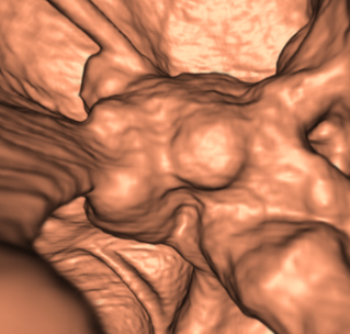 A CT scan of a colon during a virtual colonoscopy.