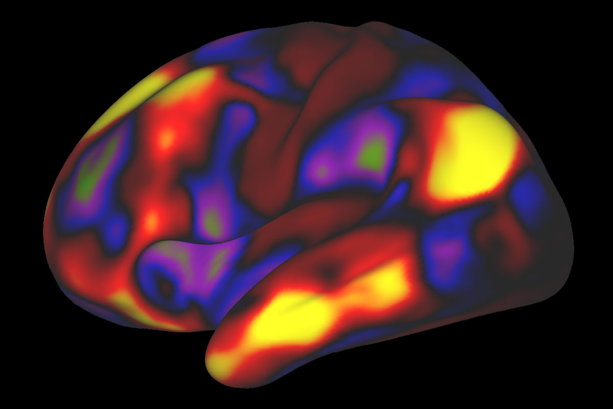 A functional MRI scan reveals the default mode network in the brain of a person at rest.