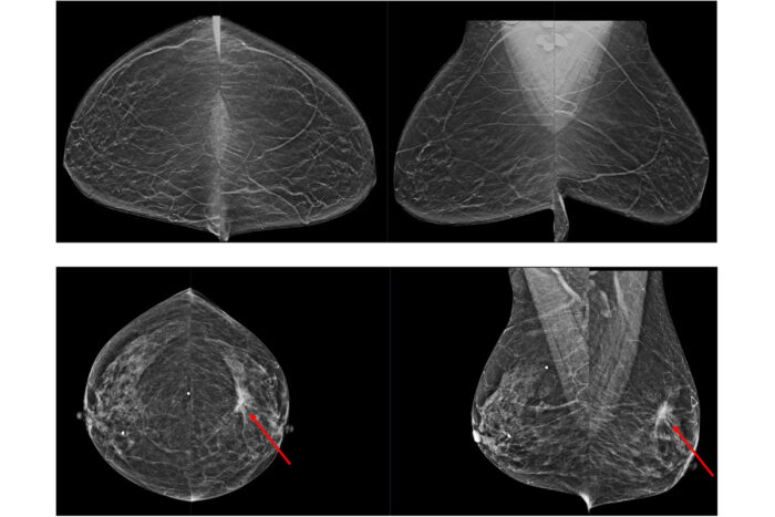 Breast imaging of a mammogram screening, with arrow detecting disease
