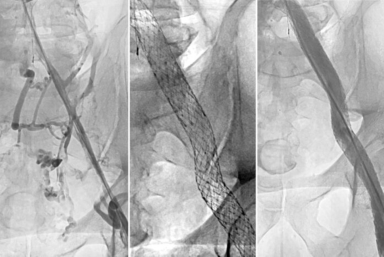 C-TRACT Trial Finds Minimally Invasive Procedure Relieves Post-Thrombotic Syndrome Symptoms