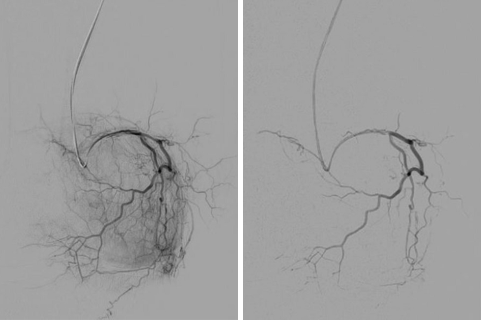 Side-by-side comparison of blood vessels in the knee before and after a genicular artery embolization (GAE).